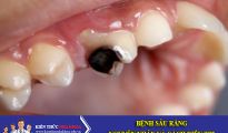 Bệnh sâu răng - nguyên nhân và cách điều trị