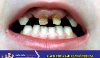 Cách chữa sâu răng ở Trẻ Em