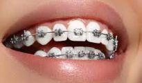 Niềng răng ở độ tuổi nào là thích hợp?