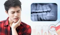 Loại bỏ răng khôn – Dẹp yên những cơn đau nhức, bảo vệ sức khỏe răng miệng