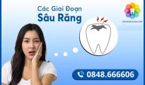 Các giai đoạn sâu răng và phương án xử lý tương ứng ?