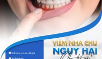 Viêm nhà chu hại như thế nào? Đừng để mất răng mới bắt đầu lo?
