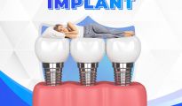 Tại sao mất răng nên cấy ghép implant