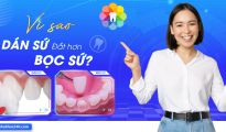 Vì sao Dán sứ đắt hơn Bọc sứ?