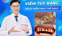 Viêm tủy răng là gì? Nguyên nhân và cách điều trị