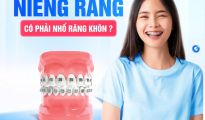 NIỀNG RĂNG - CÓ CẪN NHỔ RĂNG KHÔN