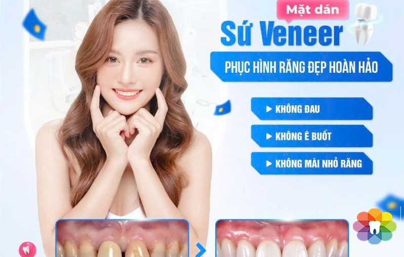MẶT DÁN SỨ VENEER – PHỤC HÌNH RĂNG ĐẸP TỰ NHIÊN, BẢO TỒN RĂNG THÂT