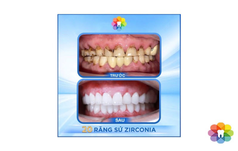 PHỤC HÌNH 20 RĂNG SỨ ZIRCONIA-GIẢI PHÁP THẨM MỸ TOÀN HÀM TẠI NHA KHOA THÁI BÌNH