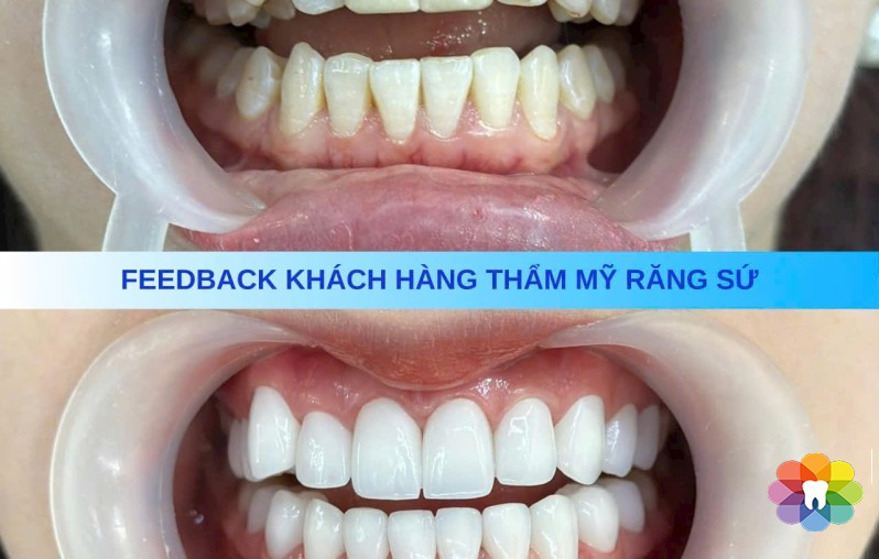 PHỤC HÌNH 20 RĂNG SỨ ZIRCONIA-GIẢI PHÁP THẨM MỸ TOÀN HÀM TẠI NHA KHOA THÁI BÌNH