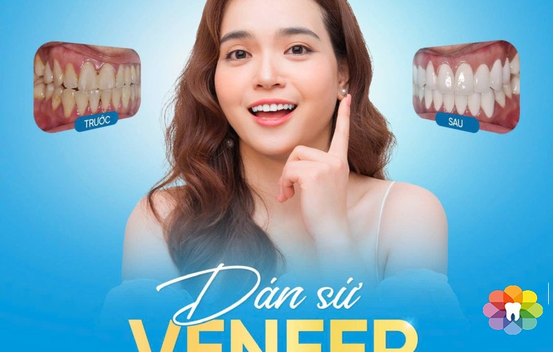 DÁN SỨ VENEER – GIẢI PHÁP KIẾN TẠO NỤ CƯỜI TỰ NHIÊN, HẠN CHẾ MÀI RĂNG