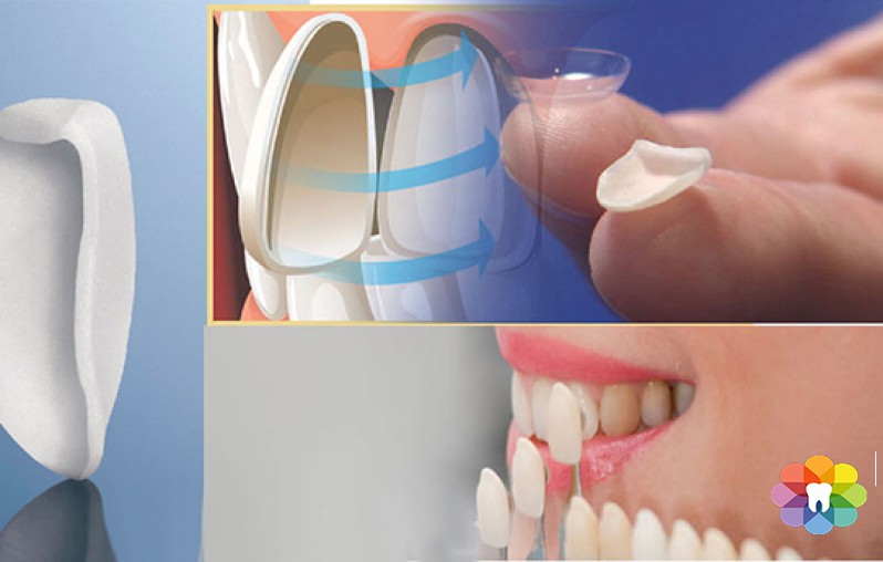 Mặt dán sứ Veneer – Phục hình răng đẹp hoàn hảo, bảo tồn răng thật tối đa